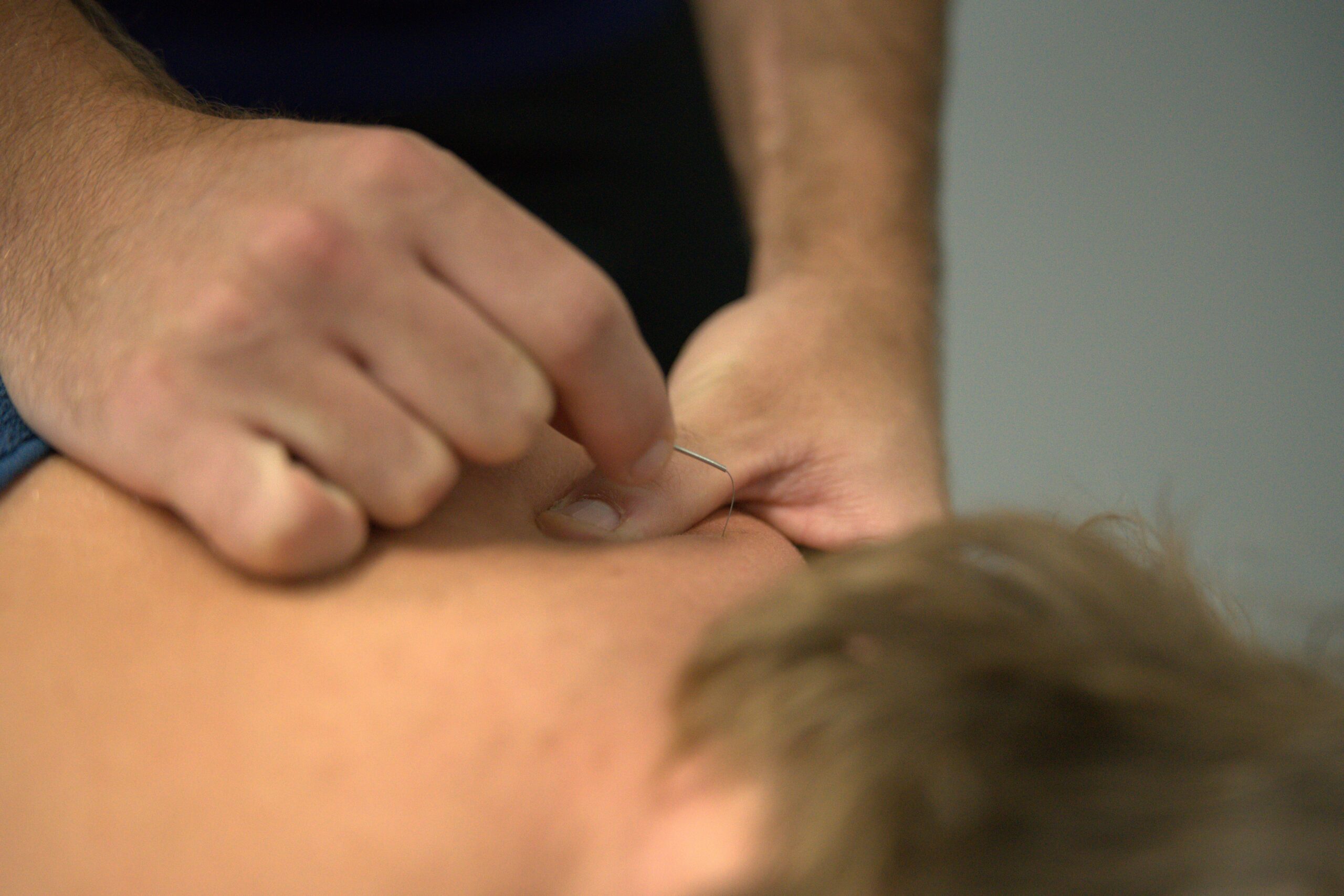 Dry needling neck