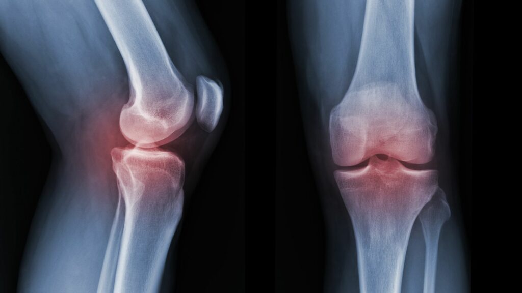 xray of acl injury
